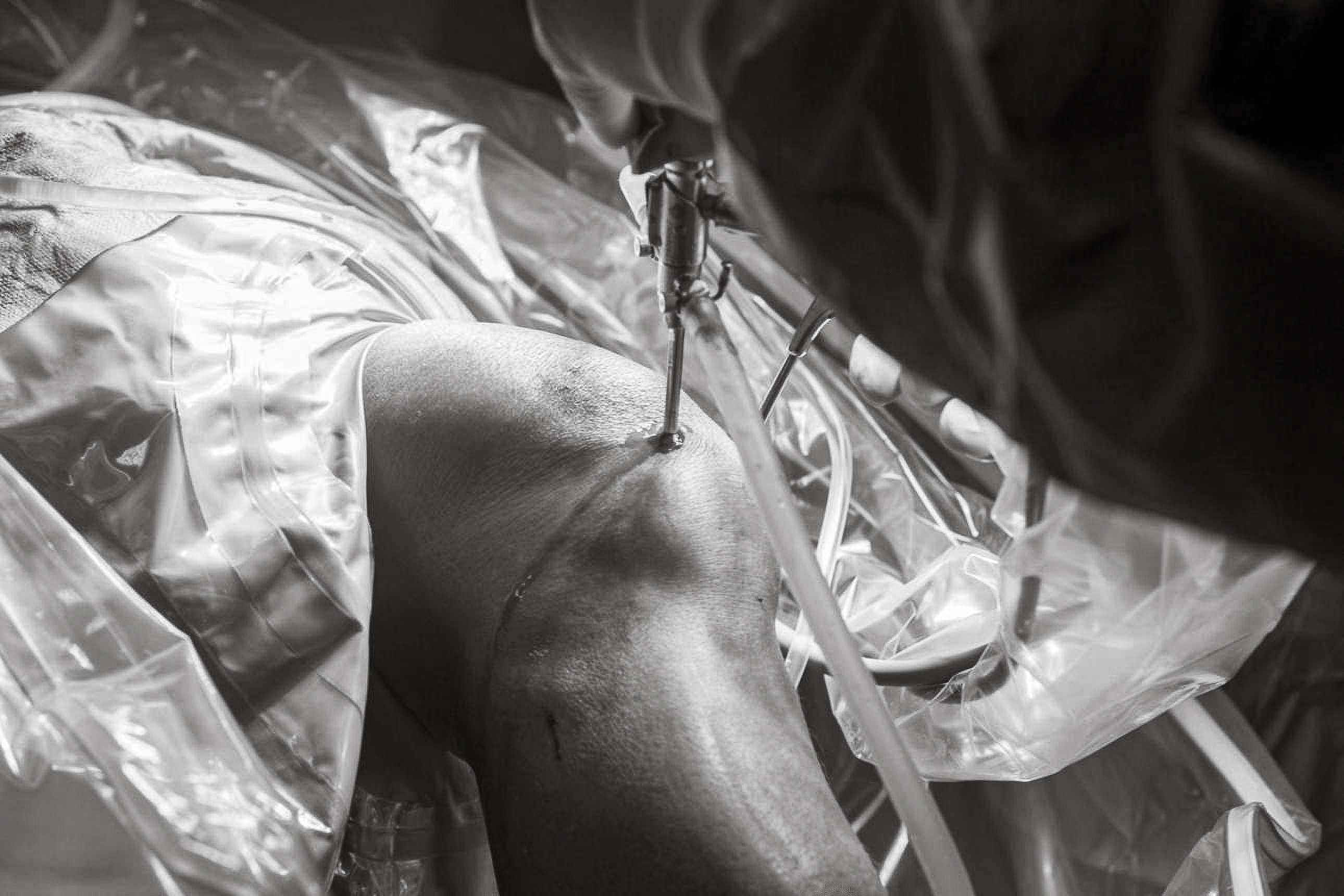 ACL reconstruction surgery in progress