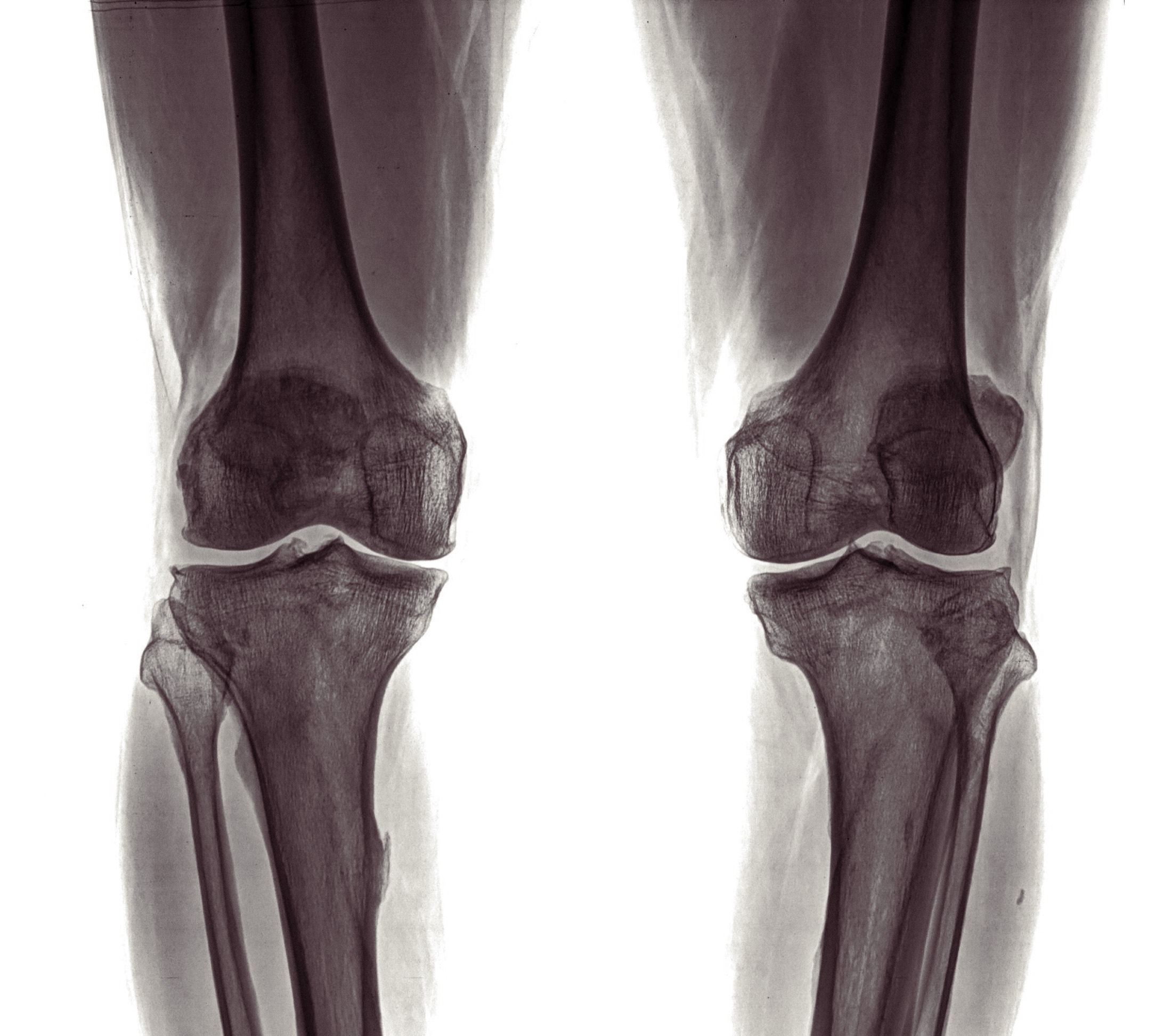 Frontal radiograph of both knees